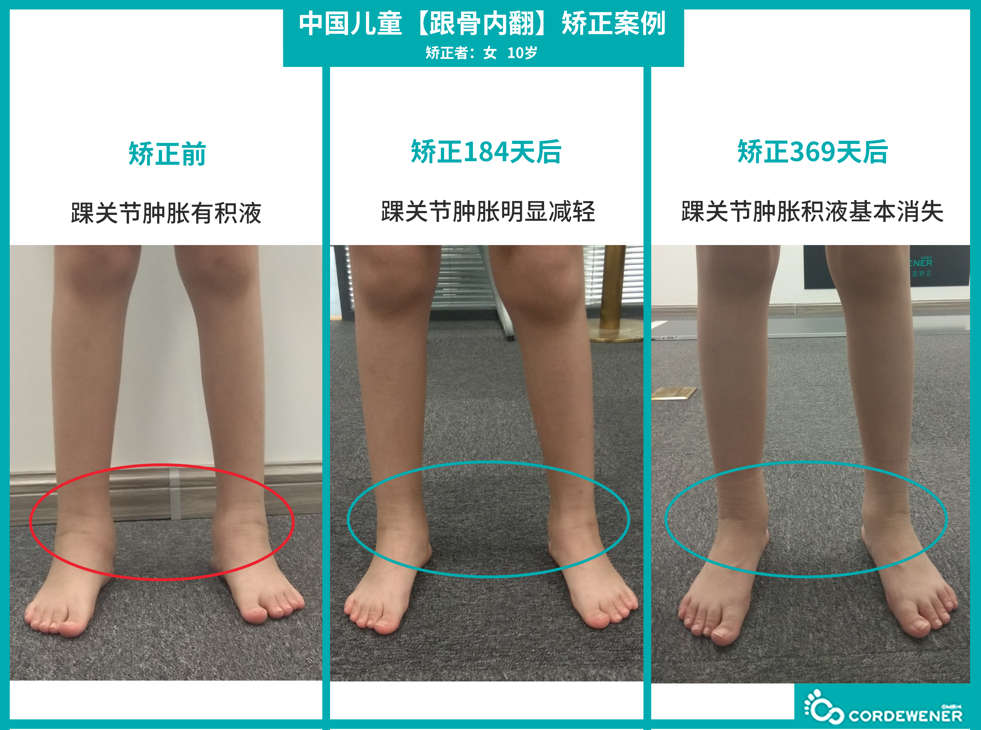 【动态对比】第一次检测跟骨内翻,双足外旋,左足16.2度,右足16.