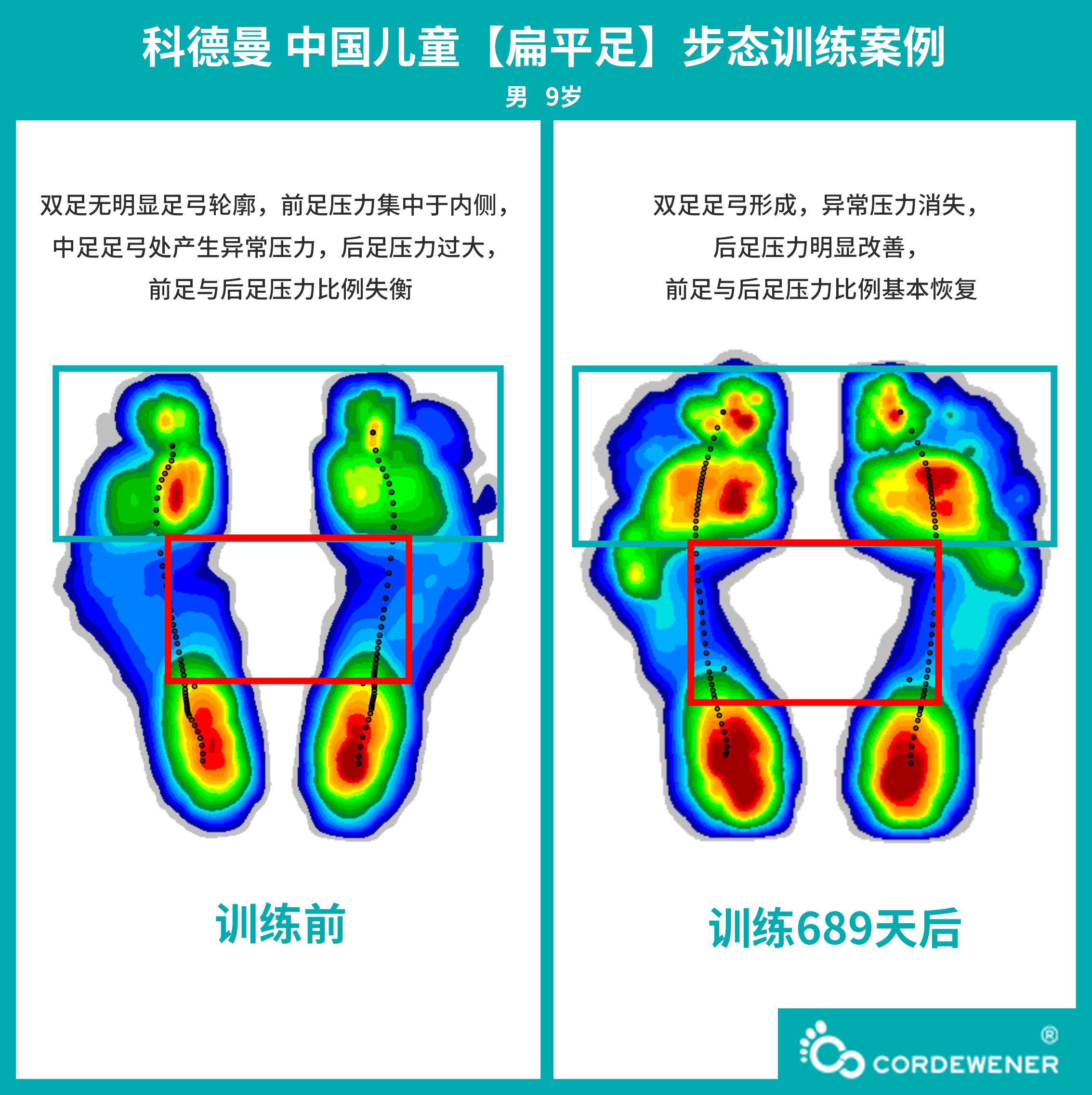 科德曼|儿童步态训练案例展示--扁平足案例二