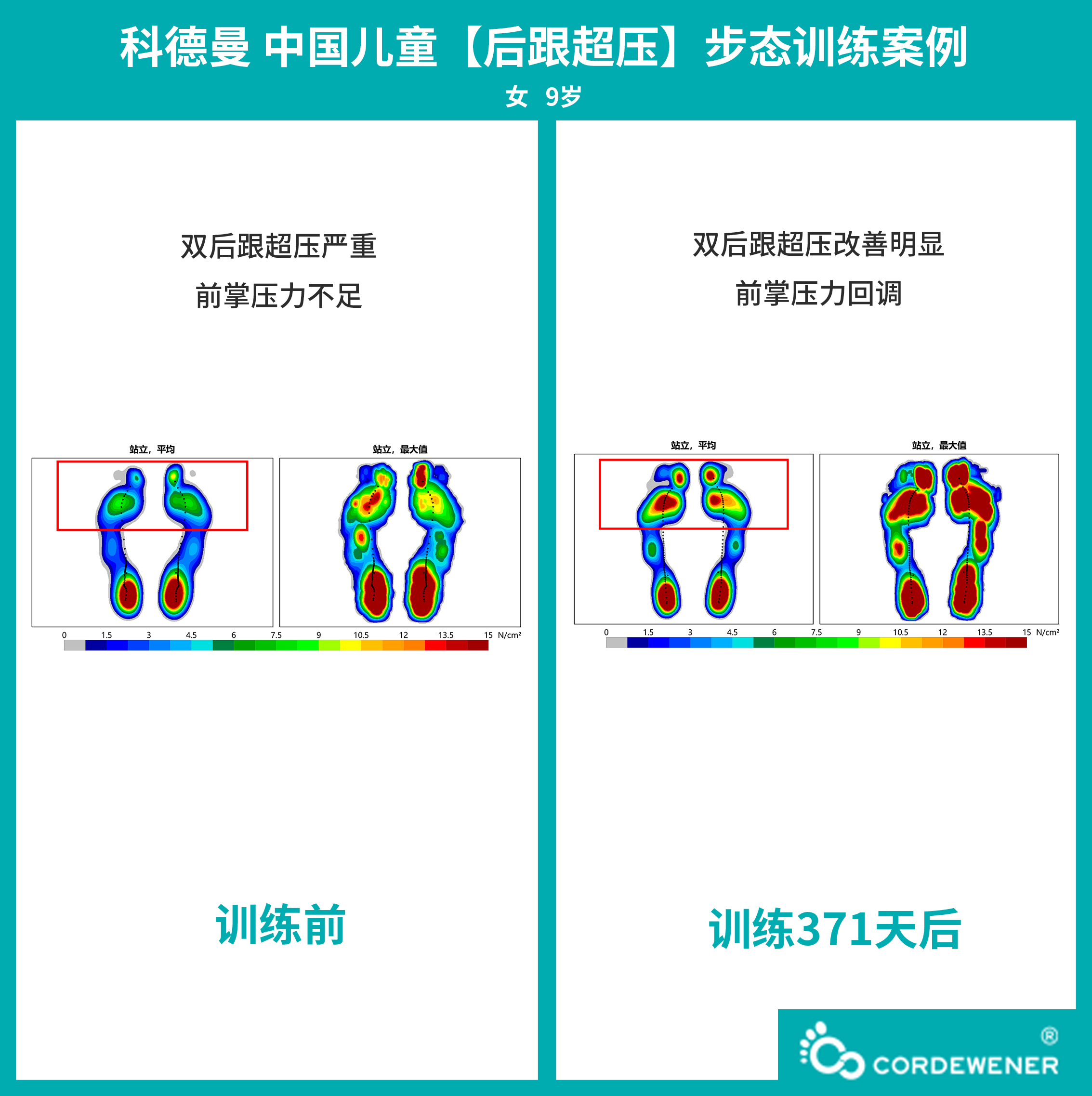 科德曼|儿童步态训练案例展示--后跟超压