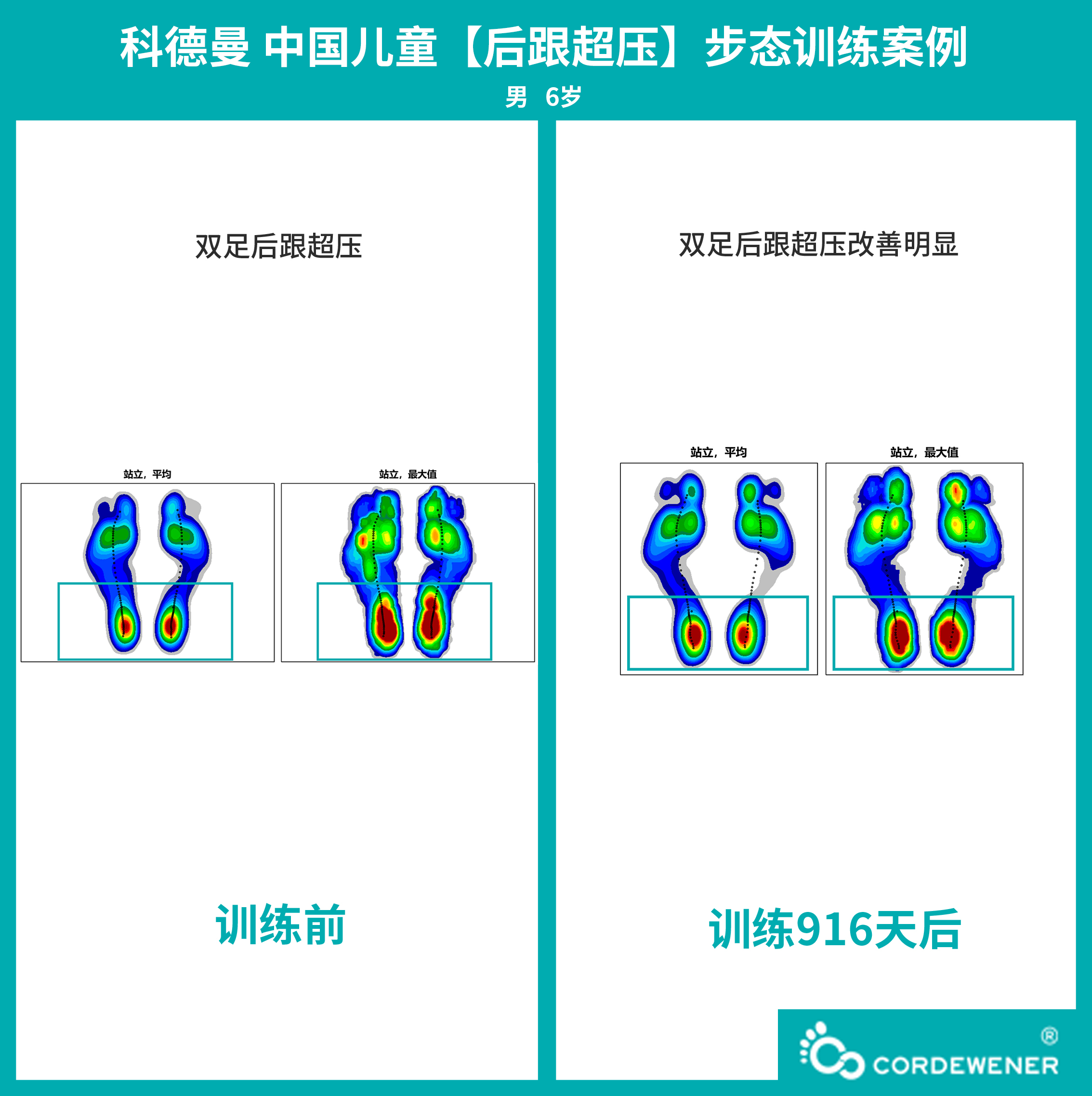 科德曼|儿童步态训练案例展示--后跟超压案例二