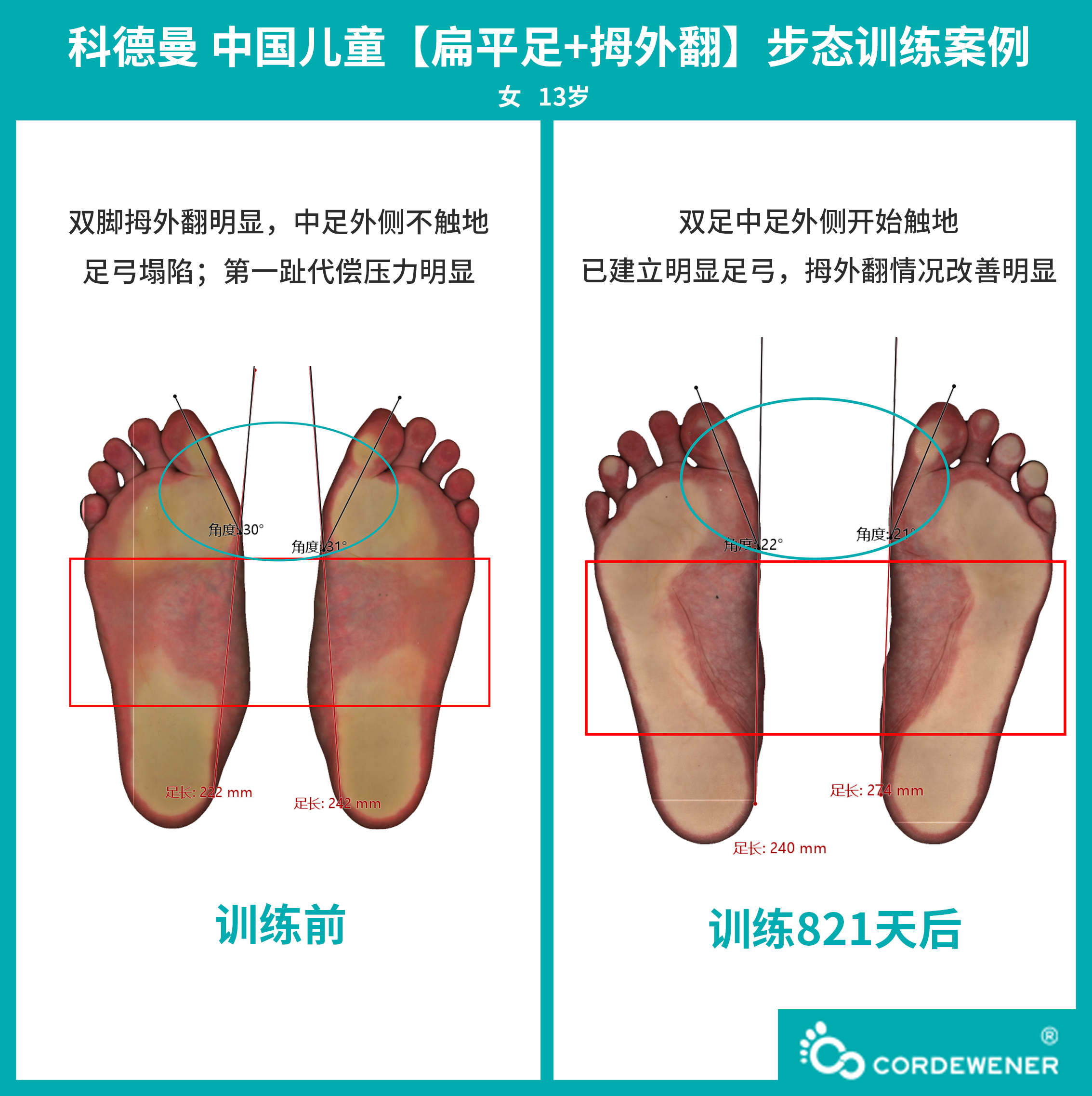 科德曼|儿童步态训练案例展示--扁平足+拇外翻