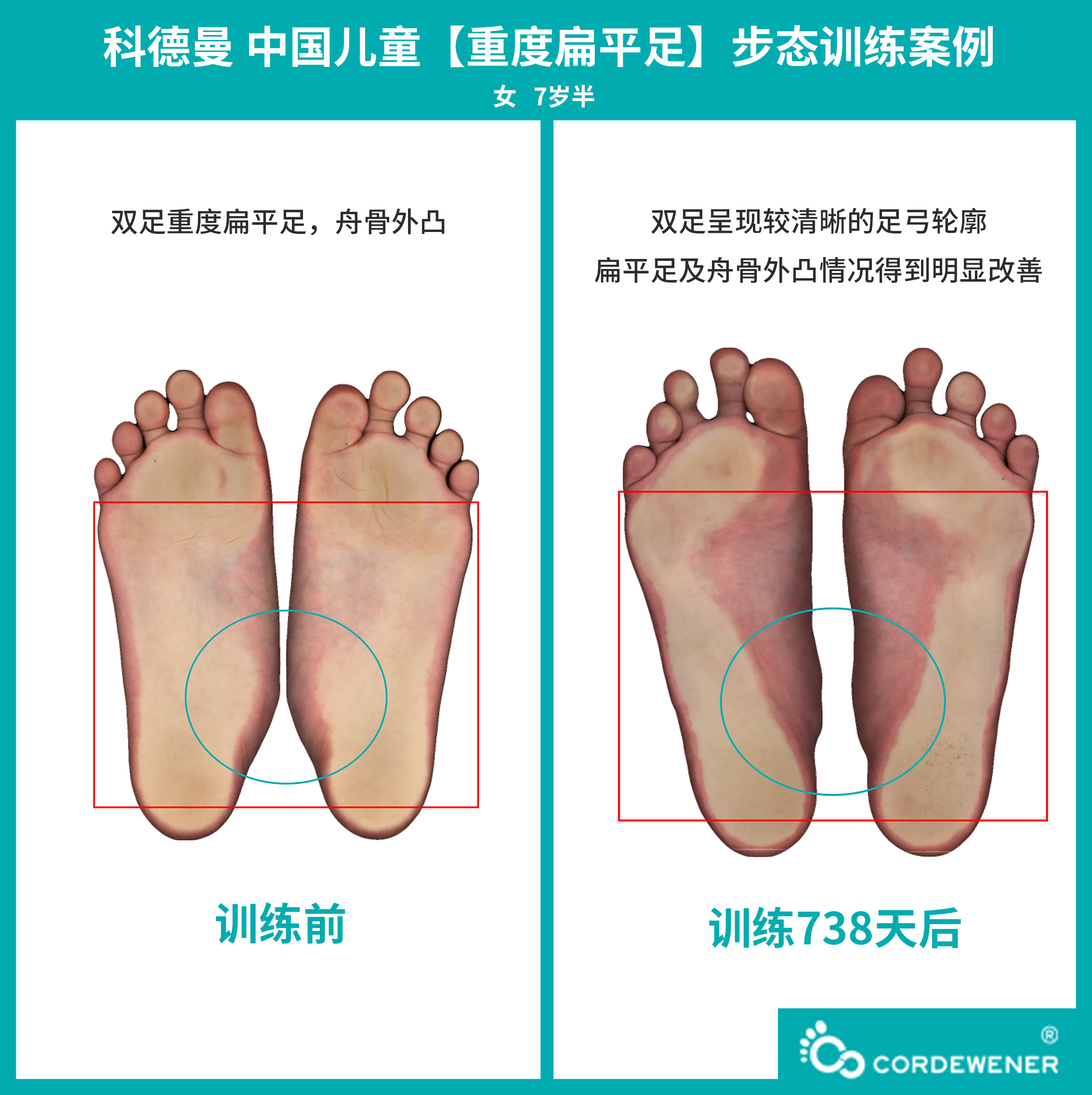 科德曼|儿童步态训练案例展示--重度扁平足案例二