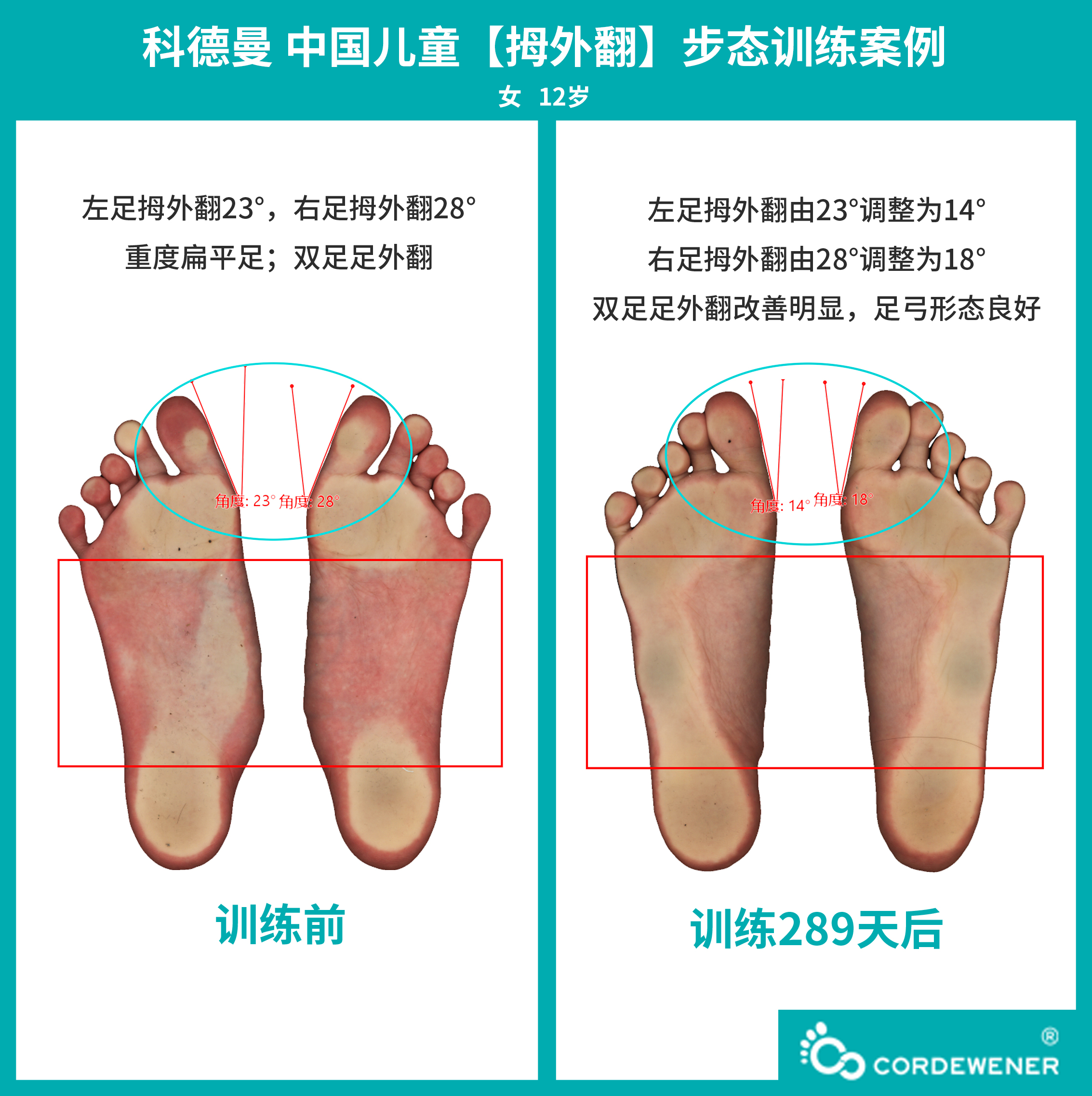 科德曼|儿童步态训练案例展示--拇外翻案例三