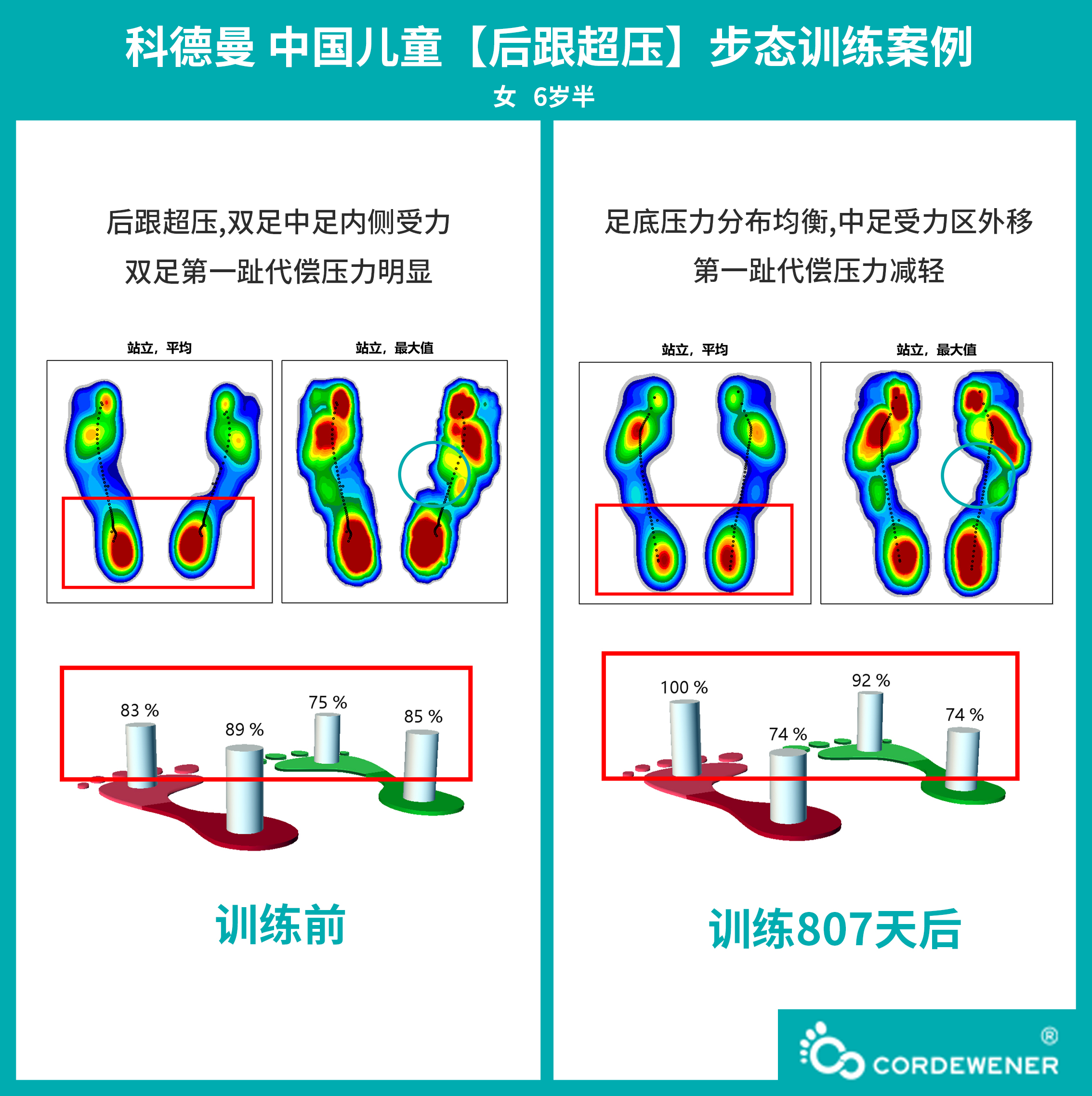 科德曼|儿童步态训练案例展示--失衡性外旋+后跟超压