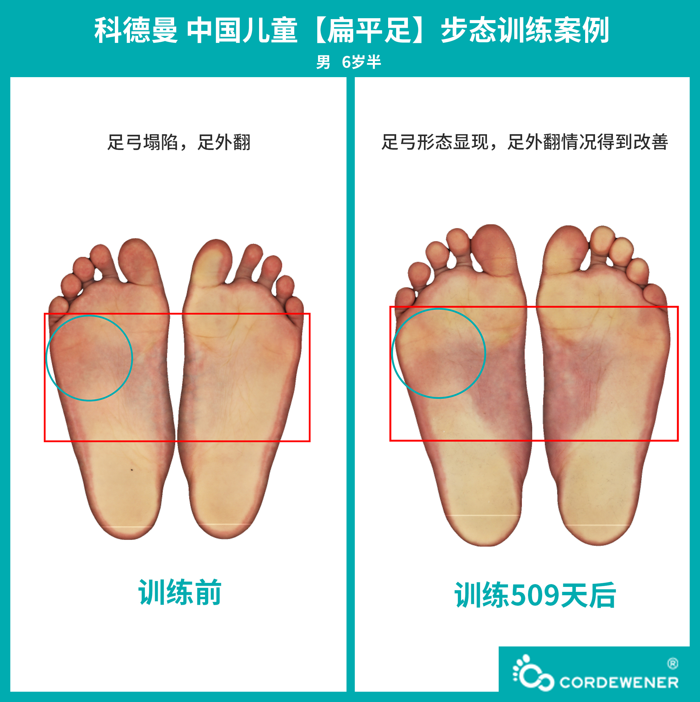 科德曼|儿童步态训练案例展示--扁平足案例十