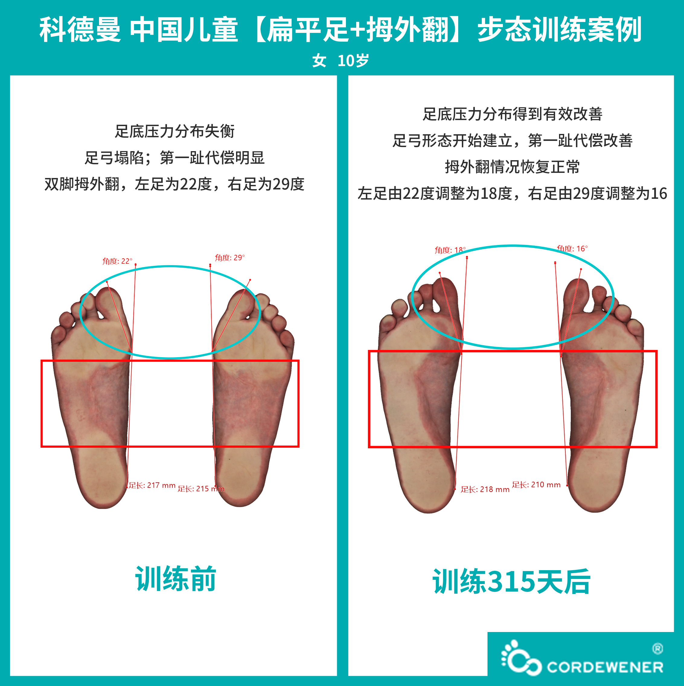 科德曼|儿童步态训练案例展示--扁平足+拇外翻案例二