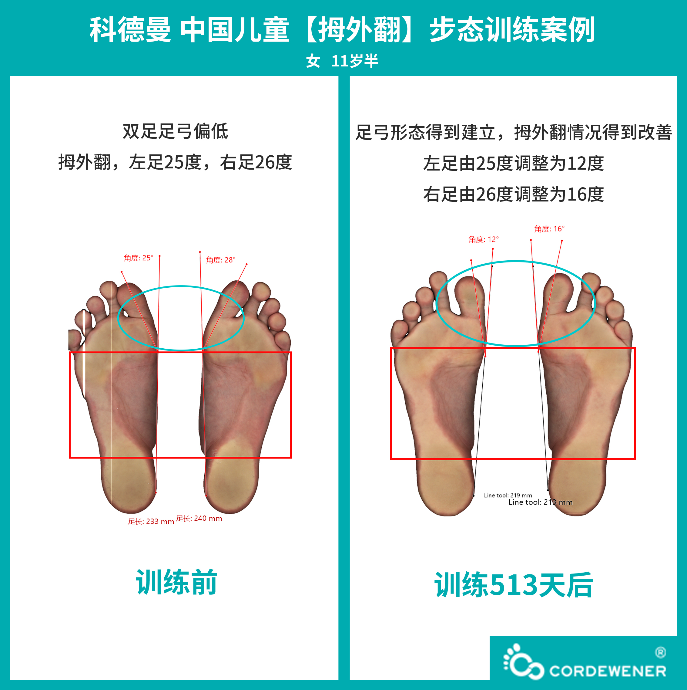 科德曼|儿童步态训练案例展示--拇外翻案例四