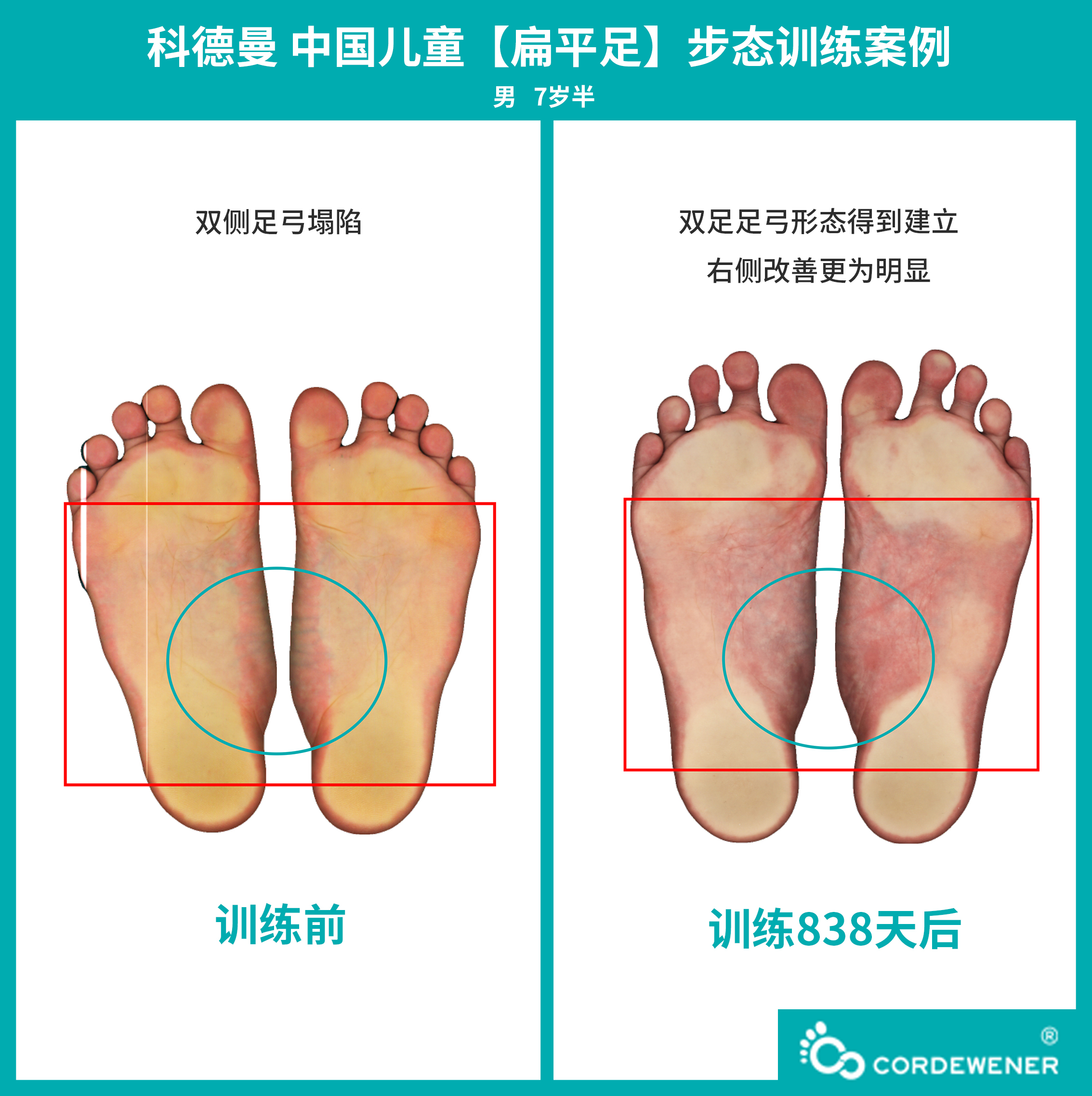 科德曼|儿童步态训练案例展示--扁平足案例十一