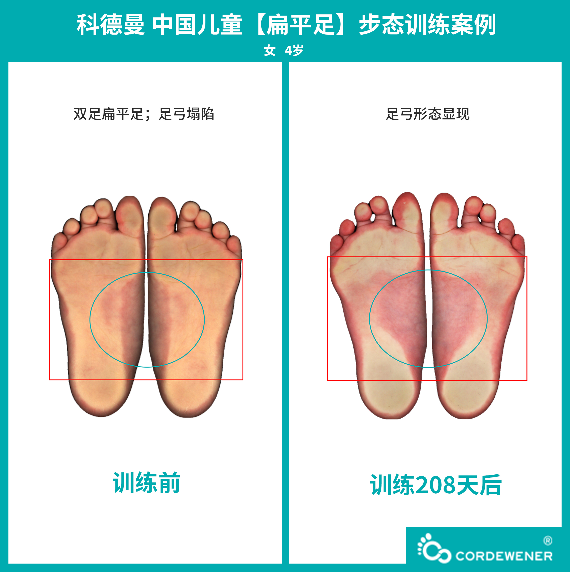 科德曼|儿童步态训练案例展示--扁平足+内旋案例八