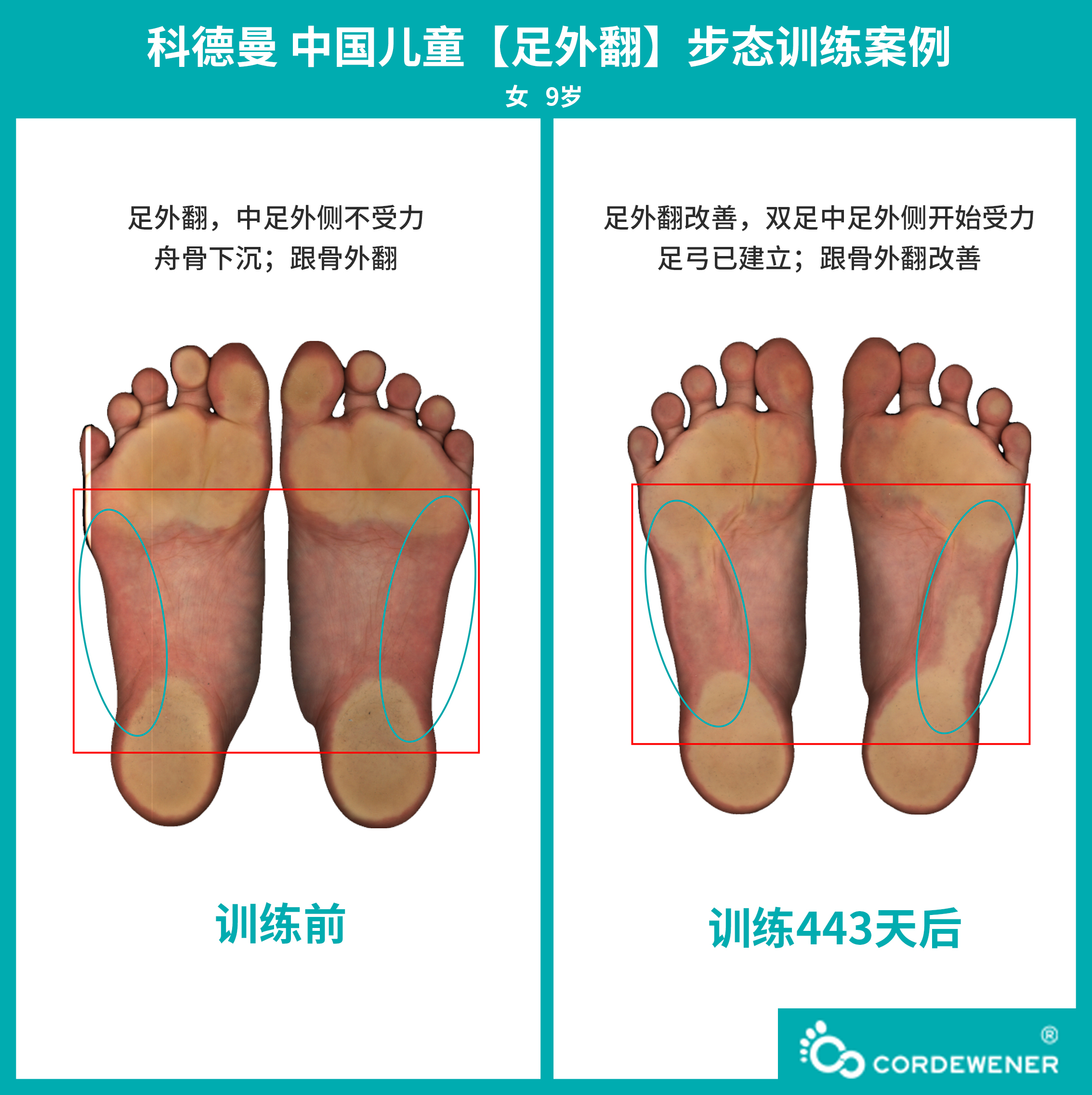 科德曼|儿童步态训练案例展示--足外翻案例