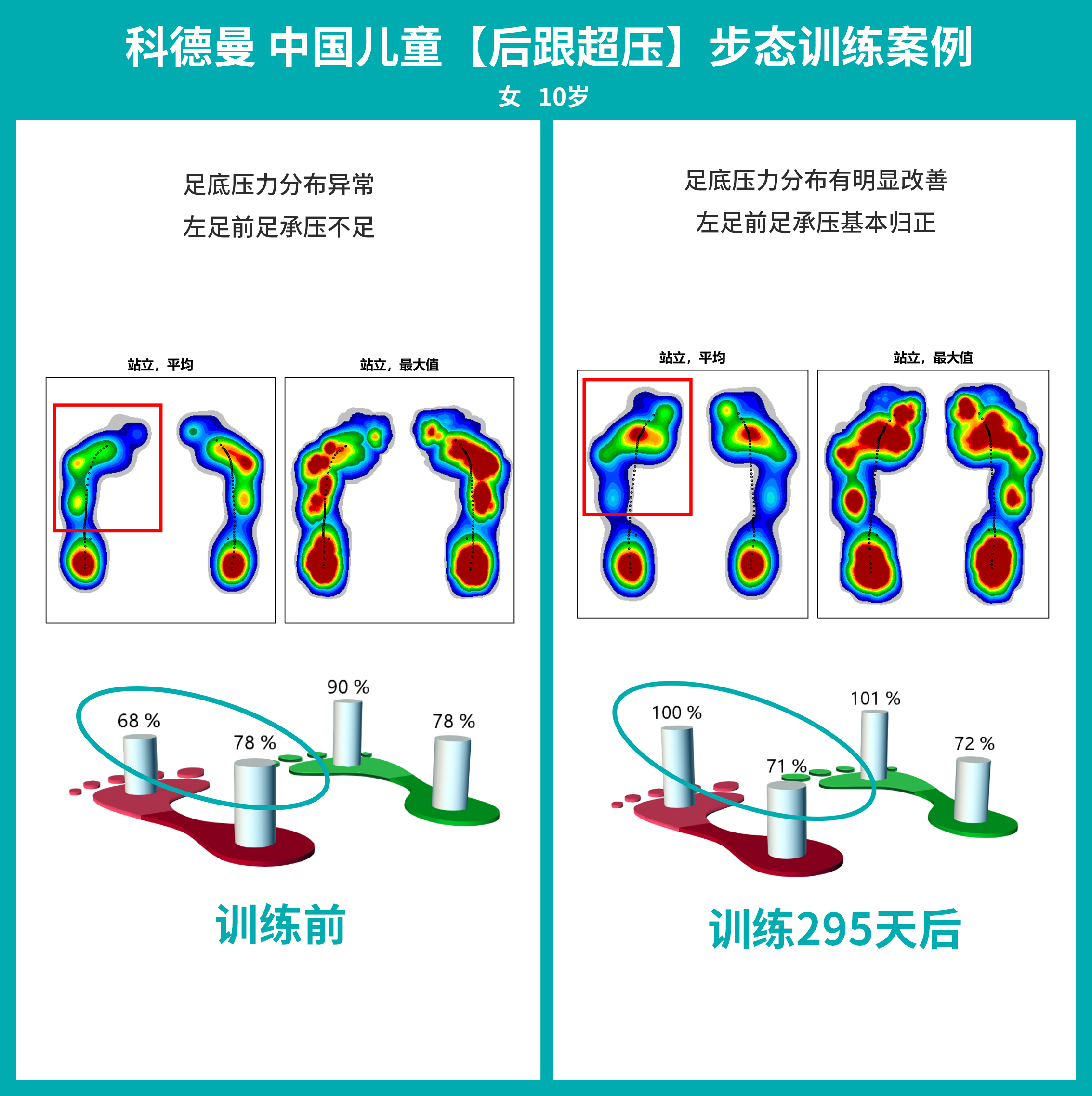 科德曼|儿童步态训练案例展示--足后跟超压案例六