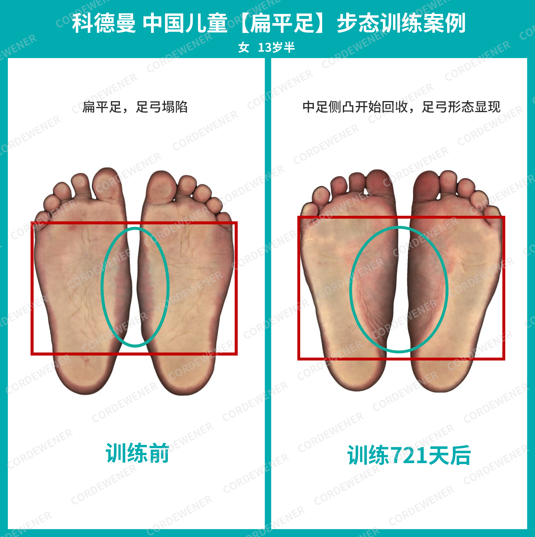 科德曼|儿童步态训练案例展示--重度扁平足+内旋